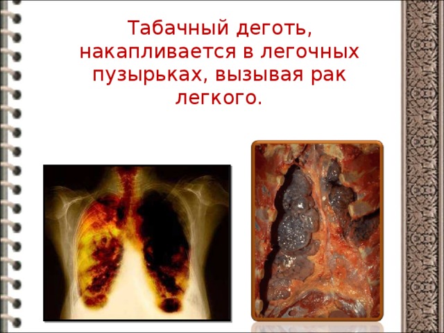  Табачный деготь, накапливается в легочных пузырьках, вызывая рак легкого. 