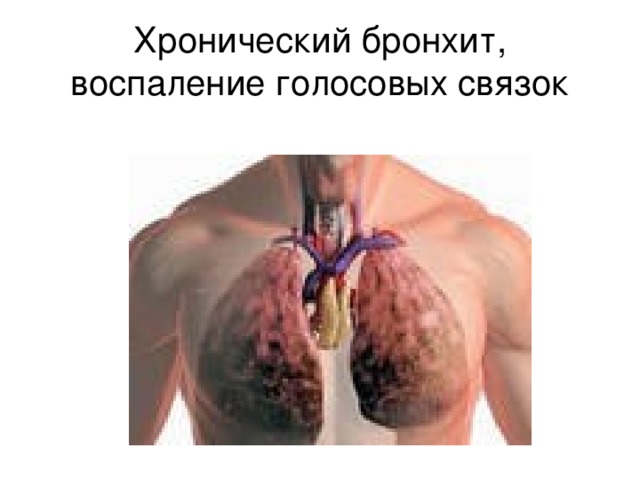 Хронический бронхит, воспаление голосовых связок 