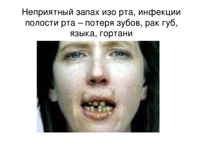 Неприятный запах изо рта, инфекции полости рта – потеря зубов, рак губ,  языка,  гортани 