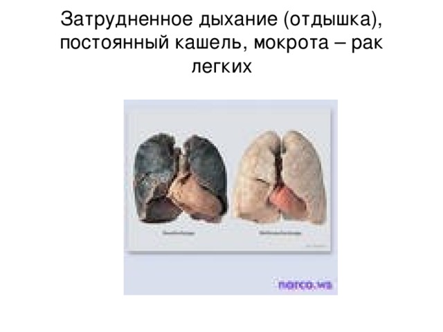 Затрудненное дыхание (отдышка), постоянный кашель, мокрота – рак легких 