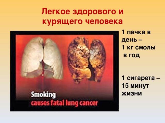 Легкое здорового и курящего человека 1 пачка в день – 1 кг смолы  в год   1 сигарета – 15 минут жизни 