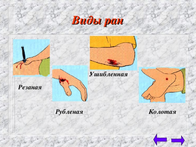 Виды ран  Ушибленная Резаная Рубленая Колотая 