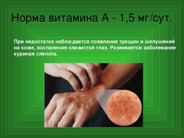 Норма витамина А - 1,5 мг/сут.  При недостатке наблюдается появление трещин и шелушений на коже, воспаления слизистой глаз. Развивается заболевание куриная слепота. 