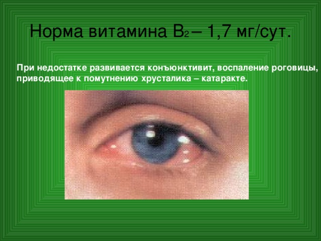 Норма витамина В 2 – 1,7 мг/сут. При недостатке развивается конъюнктивит, воспаление роговицы, приводящее к помутнению хрусталика – катаракте. 