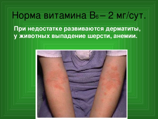 Норма витамина В 6 – 2 мг/сут. При недостатке развиваются дерматиты, у животных выпадение шерсти, анемии. 