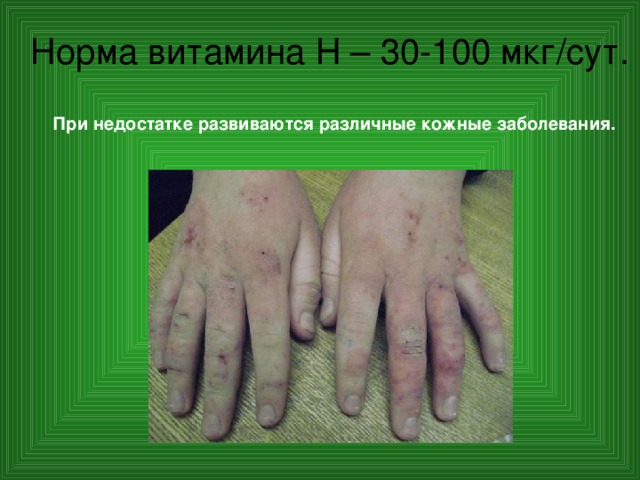 Норма витамина Н – 30-100 мкг/сут. При недостатке развиваются различные кожные заболевания. 