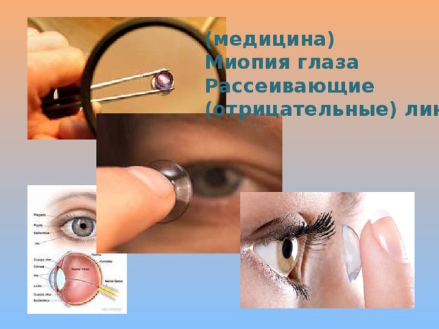 (медицина) Миопия глаза Рассеивающие (отрицательные) линзы 