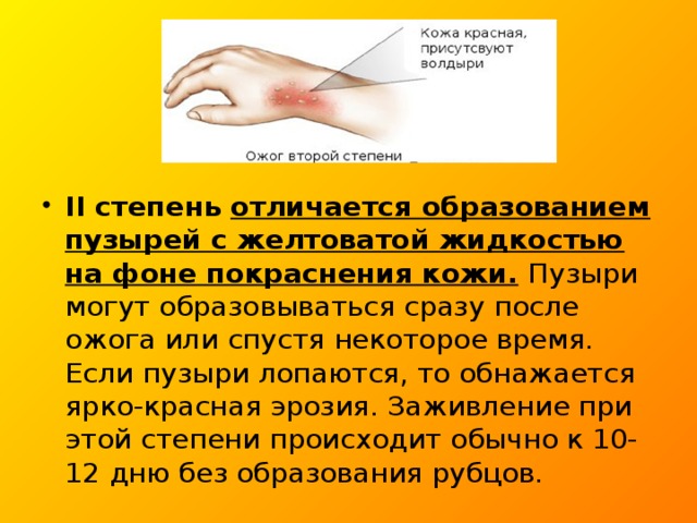 II степень  отличается образованием пузырей с желтоватой жидкостью на фоне покраснения кожи.  Пузыри могут образовываться сразу после ожога или спустя некоторое время. Если пузыри лопаются, то обнажается ярко-красная эрозия. Заживление при этой степени происходит обычно к 10-12 дню без образования рубцов. 