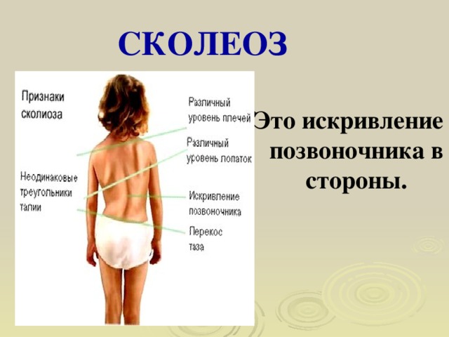 СКОЛЕОЗ Это искривление позвоночника в стороны. 