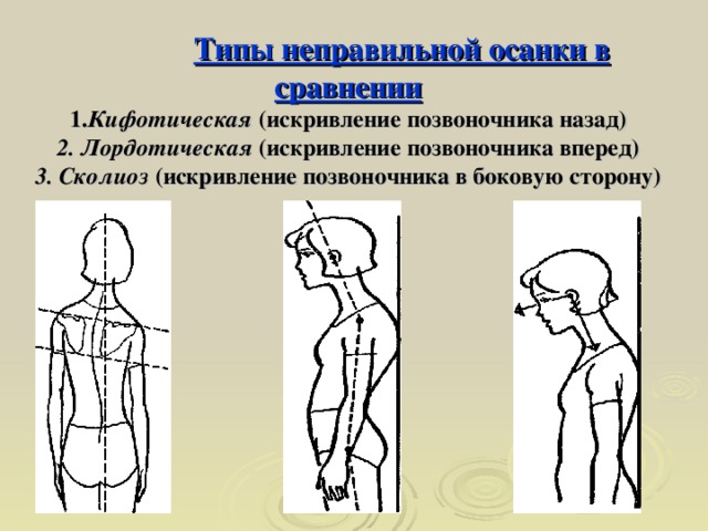 Неправильно виду. Кифотический Тип осанки. Типы неправильно осанки. Признаки неправильной осанки кифотическая осанка. Лордотическая осанка конструирование.