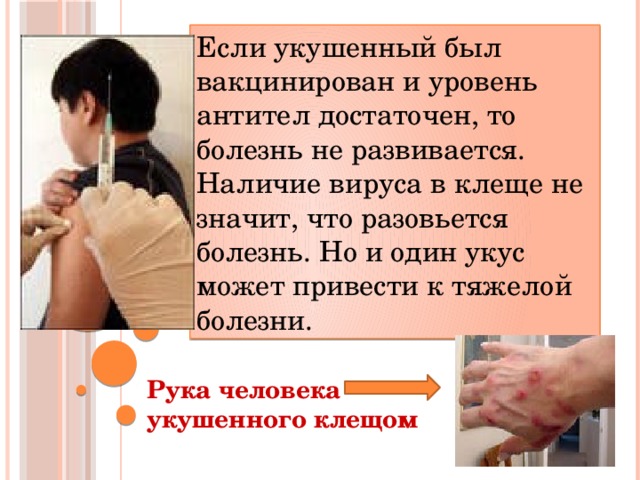 Если укушенный был вакцинирован и уровень антител достаточен, то болезнь не развивается. Наличие вируса в клеще не значит, что разовьется болезнь. Но и один укус может привести к тяжелой болезни. Рука человека укушенного клещом 