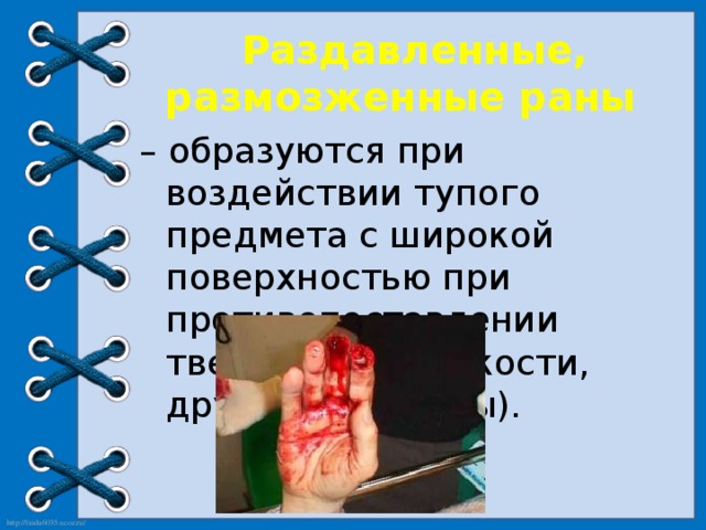  Раздавленные,  размозженные раны – образуются при воздействии тупого предмета с широкой поверхностью при  противопоставлении твердой опоры (кости,  другие предметы). 