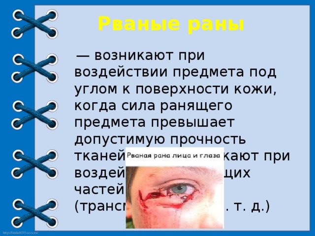  Рваные раны   — возникают при воздействии предмета под углом к поверхности кожи, когда сила ранящего предмета превышает допустимую прочность тканей. Чаще возникают при воздействии движущих частей механизмов (трансмиссий, пил и. т. д.)  