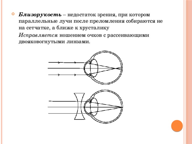 Презентация близорукость и дальнозоркость