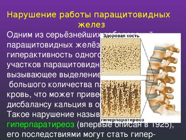 Нарушение работы паращитовидных  желез Одним из серьёзнейших заболеваний паращитовидных желёз считается гиперактивность одного или более участков паращитовидных желёз, вызывающее выделение слишком  большого количества паратгормона в кровь, что может привести к серьёзному дисбалансу кальция в организме. Такое нарушение называется гиперпаратиреоз (впервые описан в 1925), его последствиями могут стать гипер- кальциемия и паратиреоидная остеодистрофия (болезнь Реклингхаузена). В качестве лечения гиперпаратиреоза может применяться хирургическая операция по удалению неисправного участка паращитовидной железы. 