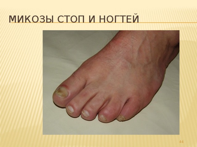 Микозы стоп и ногтей 32 