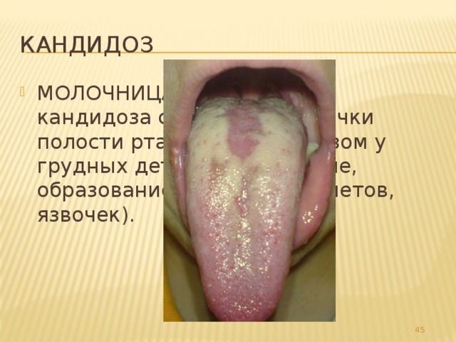 Кандидоз МОЛОЧНИЦА, одна из форм кандидоза слизистой оболочки полости рта, главным образом у грудных детей (покраснение, образование беловатых налетов, язвочек). 32 