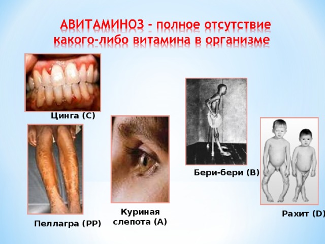 Цинга (С) Бери-бери (В) Куриная слепота (А) Рахит ( D ) Пеллагра (РР) 
