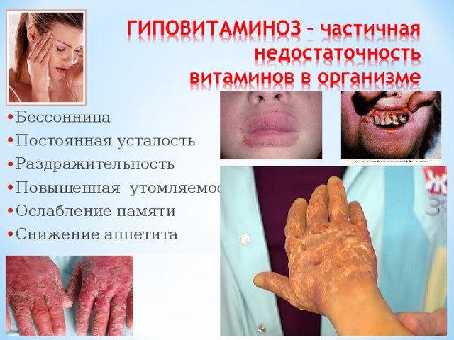 Бессонница Постоянная усталость Раздражительность Повышенная утомляемость Ослабление памяти Снижение аппетита 