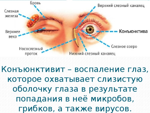 Конъюнктивит – воспаление глаз, которое охватывает слизистую оболочку глаза в результате попадания в неё микробов, грибков, а также вирусов. 