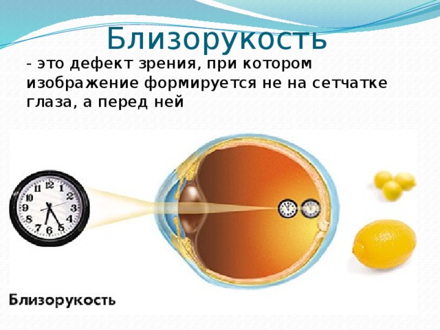 При близорукости изображение рассматриваемого глазом предмета формируется