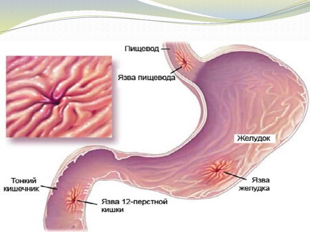 Заболевание желудка. 