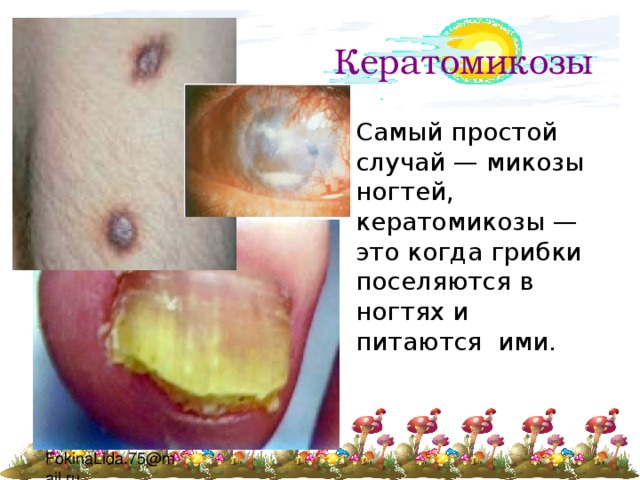 Кератомикозы Самый простой случай — микозы ногтей, кератомикозы — это когда грибки поселяются в ногтях и питаются ими. 