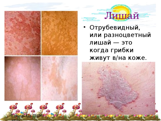 Лишай Отрубевидный, или разноцветный лишай — это когда грибки живут в/на коже. Не больно, но некрасиво 