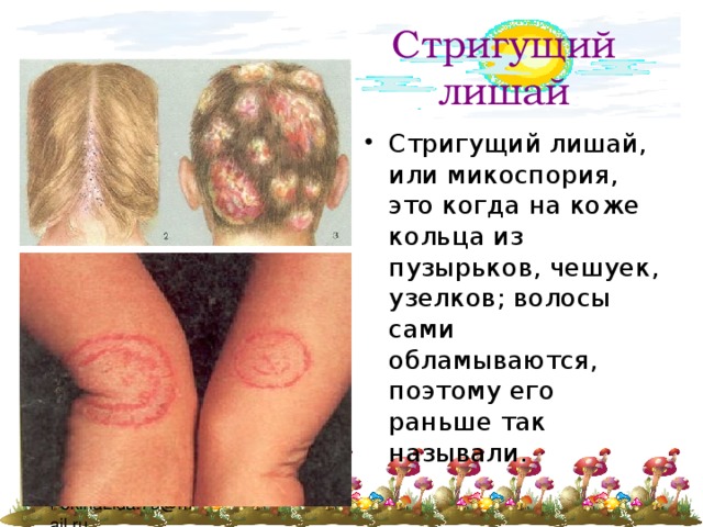 Стригущий лишай Стригущий лишай, или микоспория, это когда на коже кольца из пузырьков, чешуек, узелков; волосы сами обламываются, поэтому его раньше так называли. 