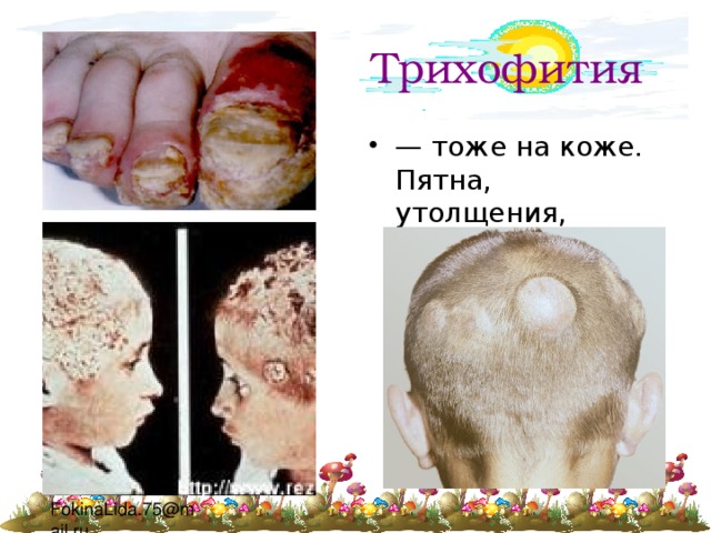 Трихофития — тоже на коже. Пятна, утолщения, всякие. 