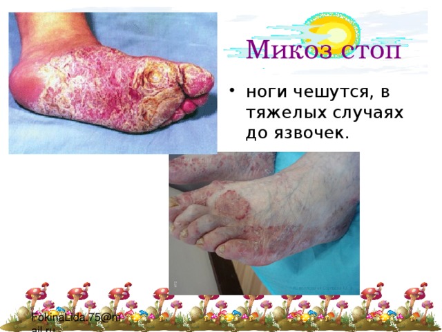 Микоз стоп ноги чешутся, в тяжелых случаях до язвочек. 