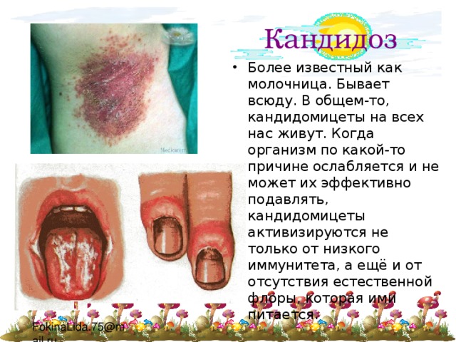 Кандидоз Более известный как молочница. Бывает всюду. В общем-то, кандидомицеты на всех нас живут. Когда организм по какой-то причине ослабляется и не может их эффективно подавлять, кандидомицеты активизируются не только от низкого иммунитета, а ещё и от отсутствия естественной флоры, которая ими питается. 