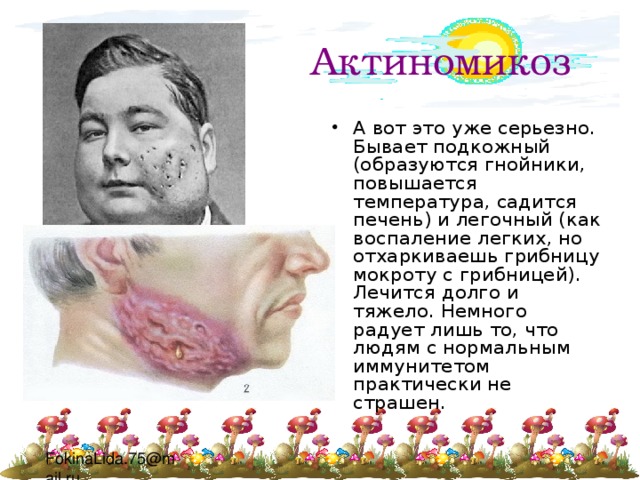 Актиномикоз А вот это уже серьезно. Бывает подкожный (образуются гнойники, повышается температура, садится печень) и легочный (как воспаление легких, но отхаркиваешь грибницу мокроту с грибницей). Лечится долго и тяжело. Немного радует лишь то, что людям с нормальным иммунитетом практически не страшен. 