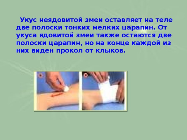  Укус неядовитой змеи оставляет на теле две полоски тонких мелких царапин. От укуса ядовитой змеи также остаются две полоски царапин, но на конце каждой из них виден прокол от клыков.   