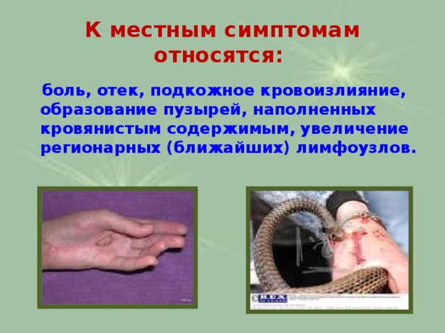 К местным симптомам относятся:  боль, отек, подкожное кровоизлияние, образование пузырей, наполненных кровянистым содержимым, увеличение регионарных (ближайших) лимфоузлов.   