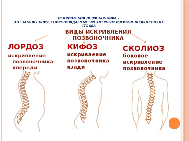 На рисунке отражено заболевание которое называется дистрофия патологический лордоз сколиоз впр