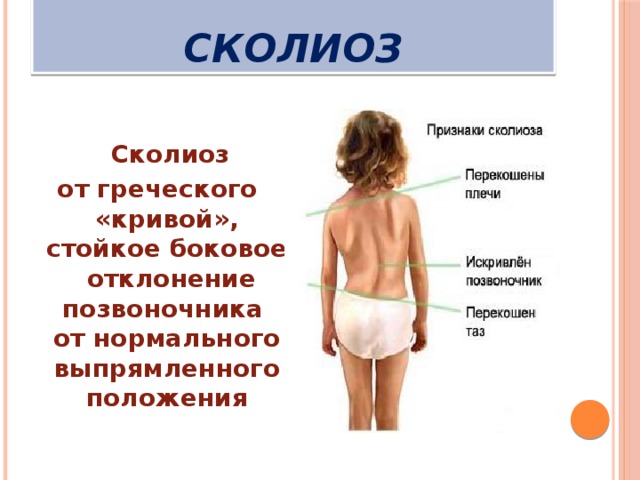 Сколиоз картинки для презентации