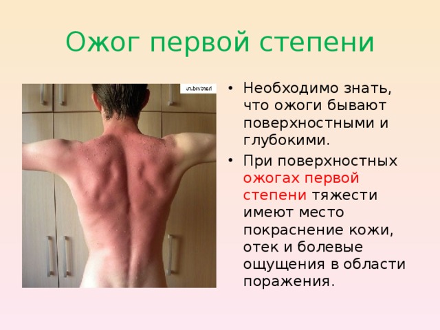 Ожог первой степени Необходимо знать, что ожоги бывают поверхностными и глубокими. При поверхностных ожогах первой степени тяжести имеют место покраснение кожи, отек и болевые ощущения в области поражения.  