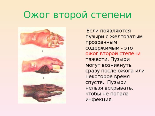 Ожог второй степени  Если появляются пузыри с желтоватым прозрачным содержимым - это ожог второй степени  тяжести. Пузыри могут возникнуть сразу после ожога или некоторое время спустя. Пузыри нельзя вскрывать, чтобы не попала инфекция. 