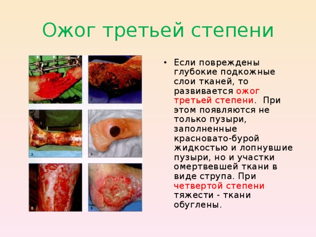 Ожог третьей степени Если повреждены  глубокие подкожные слои тканей, то развивается ожог третьей степени . При  этом появляются не только пузыри, заполненные красновато-бурой жидкостью и лопнувшие пузыри, но и участки омертвевшей ткани в виде струпа. При четвертой степени тяжести - ткани обуглены.  