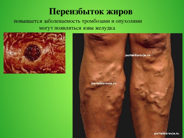 Переизбыток жиров повышается заболеваемость тромбозами и опухолями могут появляться язвы желудка 