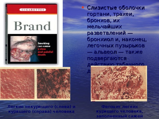 Слизистые оболочки гортани, трахеи, бронхов, их мельчайших разветвлений — бронхиол и, наконец, легочных пузырьков — альвеол — также подвергаются действию табачного дыма. Фагоцит легких курящего человека, заполненный сажей Легкие некурящего (слева) и курящего (справа) человека 