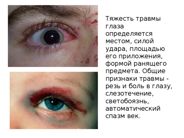 Тяжесть травмы глаза определяется местом, силой удара, площадью его приложения, формой ранящего предмета. Общие признаки травмы - резь и боль в глазу, слезотечение, светобоязнь, автоматический спазм век. 