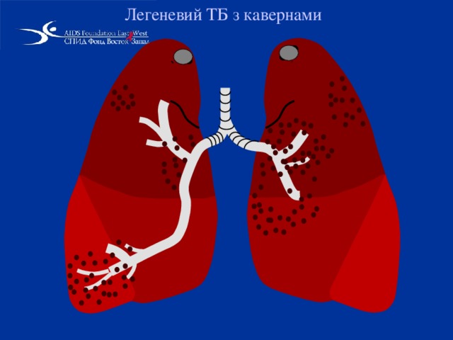 Легеневий TБ з кавернами   