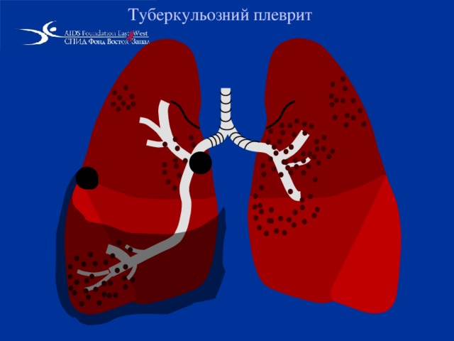 Туберкульозний плеврит  