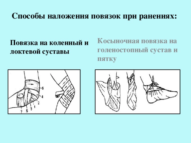 Какая повязка накладывается при повреждении голеностопного сустава. Косыночные повязки на коленный сустав. Наложение косыночной повязки на коленный сустав. Косыночная повязка на голеностопный сустав. Способы наложения повязок при ранениях.