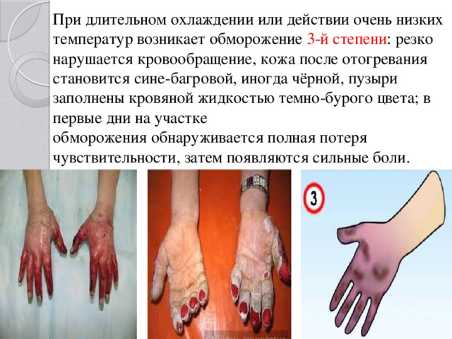 При длительном охлаждении или действии очень низких температур возникает обморожение 3-й степени : резко нарушается кровообращение, кожа после отогревания становится сине-багровой, иногда чёрной, пузыри заполнены кровяной жидкостью темно-бурого цвета; в первые дни на участке обморожения обнаруживается полная потеря чувствительности, затем появляются сильные боли. 