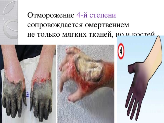 Отморожение 4-й степени сопровождается омертвением не только мягких тканей, но и костей.   
