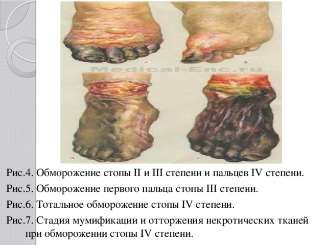 Рис.4. Обморожение стопы II и III степени и пальцев IV степени. Рис.5. Обморожение первого пальца стопы III степени. Рис.6. Тотальное обморожение стопы IV степени. Рис.7. Стадия мумификации и отторжения некротических тканей при обморожении стопы IV степени. 