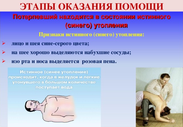ЭТАПЫ ОКАЗАНИЯ ПОМОЩИ Потерпевший находится в состоянии истинного (синего) утопления Признаки истинного (синего) утопления: лицо и шея сине-серого цвета; на шее хорошо выделяются набухшие сосуды; изо рта и носа выделяется розовая пена.  